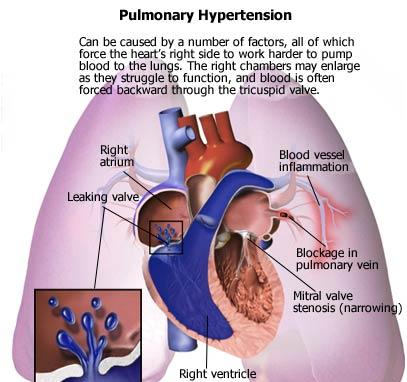 umjerene hipertenzije korijenje u hipertenzije